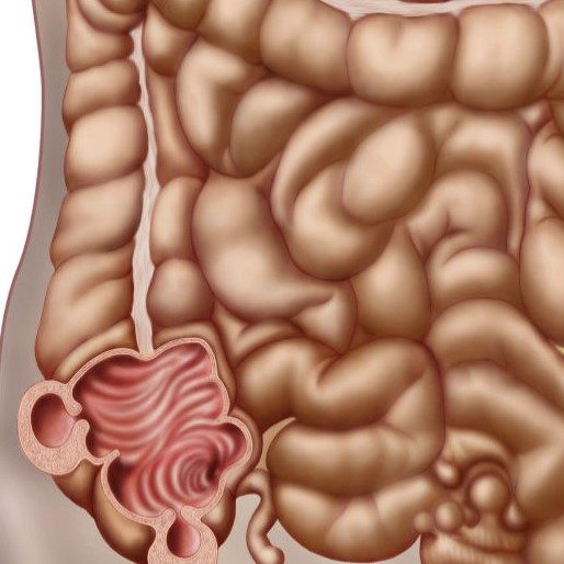 Καρκίνος του ορθού