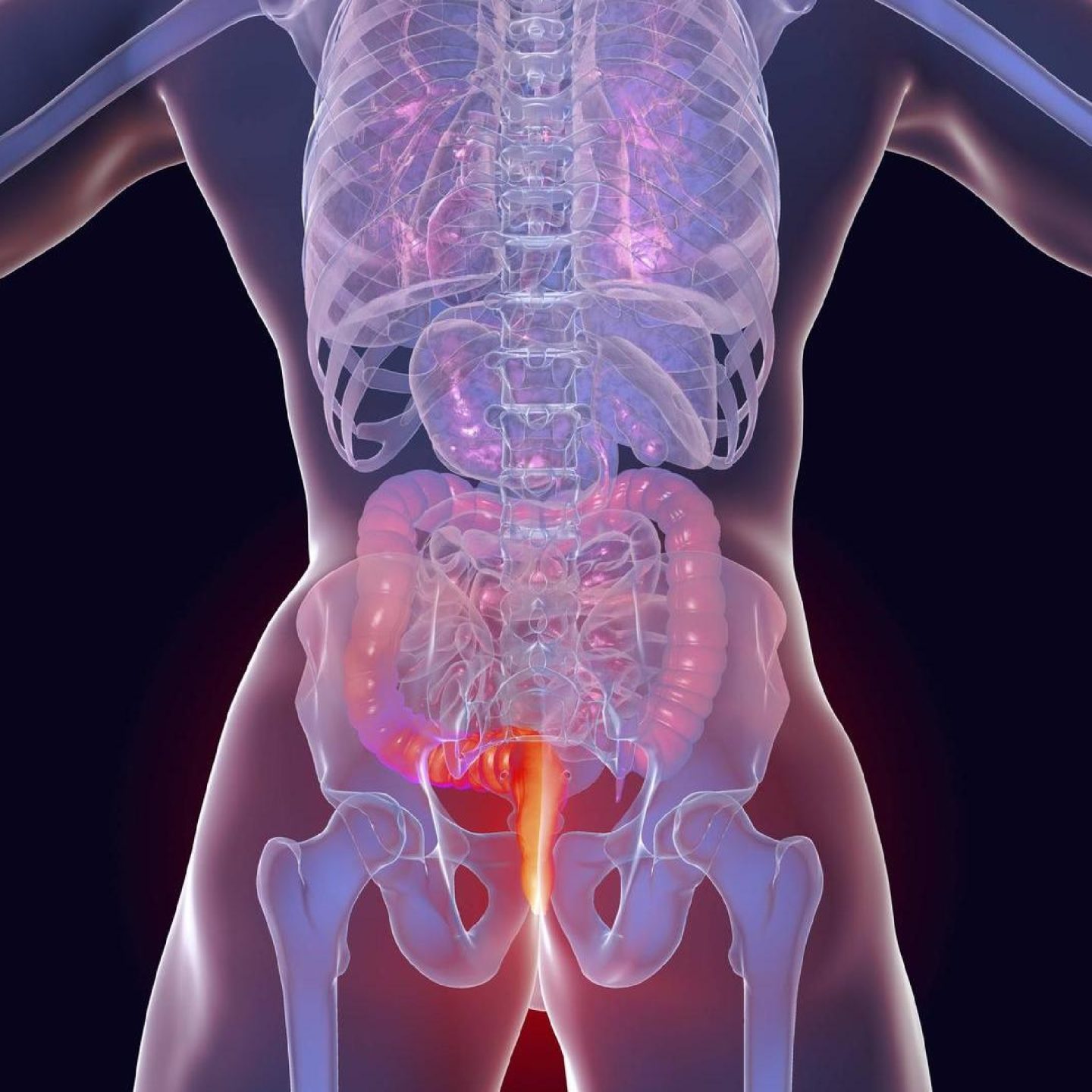 Καρκίνος του πρωκτού