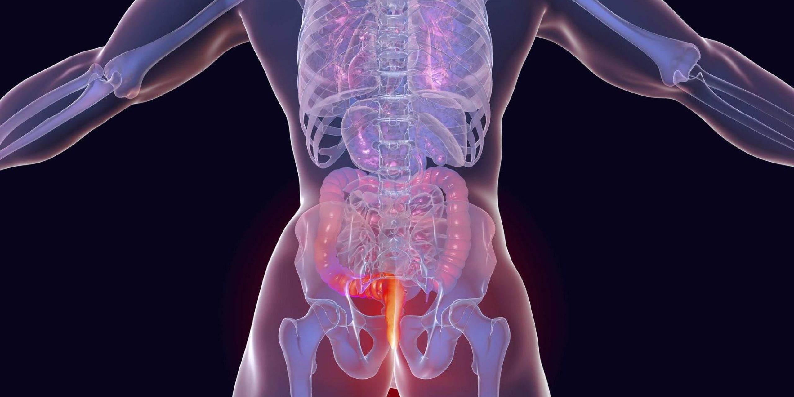 Καρκίνος του πρωκτού