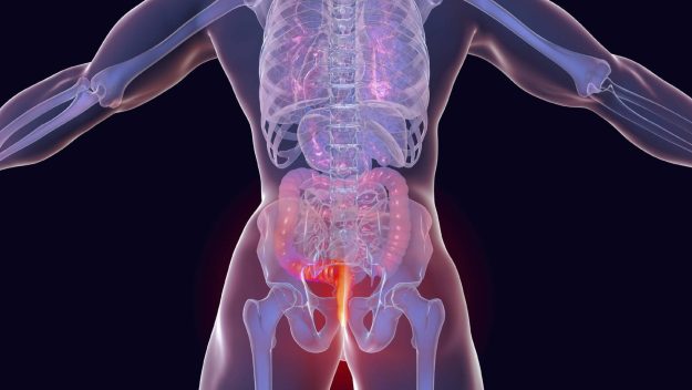 Καρκίνος του πρωκτού