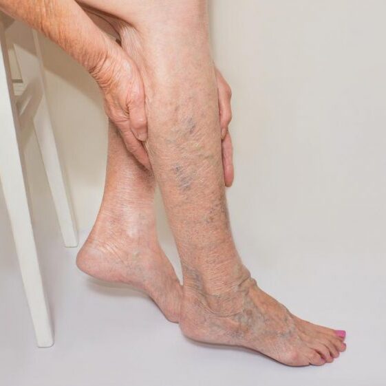 Κιρσοί Κάτω Άκρων Και Θρόμβωση