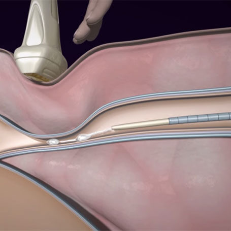 Κιρσοί Των Κάτω Άκρων. Τι Νέο Υπάρχει Μετά Το Laser;