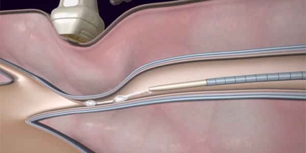 Κιρσοί Των Κάτω Άκρων. Τι Νέο Υπάρχει Μετά Το Laser; Κιρσοί Των Κάτω Άκρων. Τι Νέο Υπάρχει Μετά Το Laser;