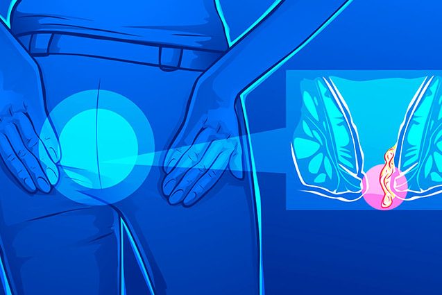 Κλινική εικόνα και διάγνωση των αιμορροΐδων