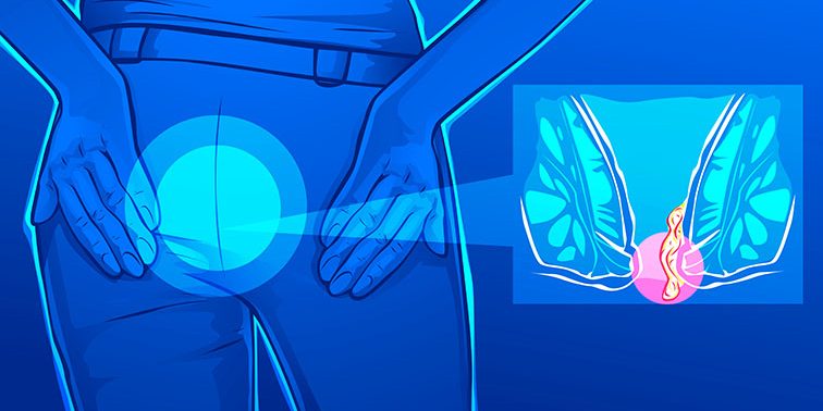 Κλινική εικόνα και διάγνωση των αιμορροΐδων