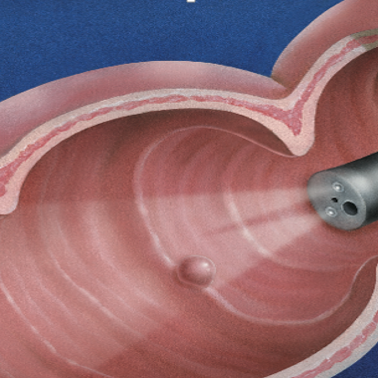 Κολονοσκόπηση, χρήση, κίνδυνοι, προετοιμασία