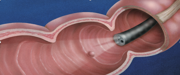 Κολονοσκόπηση, χρήση, κίνδυνοι, προετοιμασία