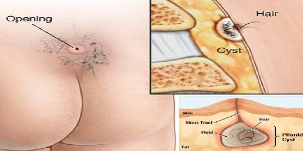 Κύστη Κόκκυγα Χειρουργείο