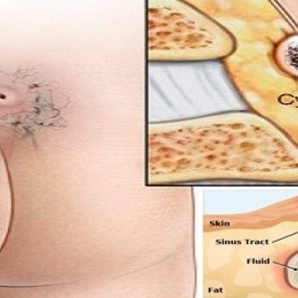 Κύστη Κόκκυγα Χειρουργείο