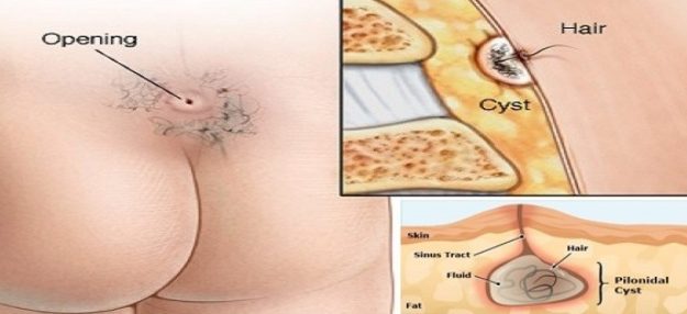 Κύστη Κόκκυγα Χειρουργείο