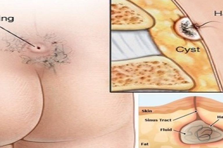 Κύστη Κόκκυγα Χειρουργείο Κύστη Κόκκυγα Χειρουργείο