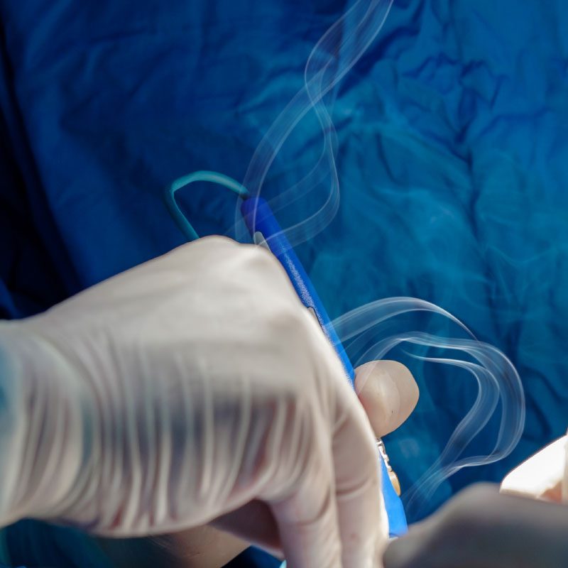 Λέιζερ επεμβάσεις παθήσεων πρωκτού Πότε εφαρμόζονται & ποια είναι τα οφέλη;