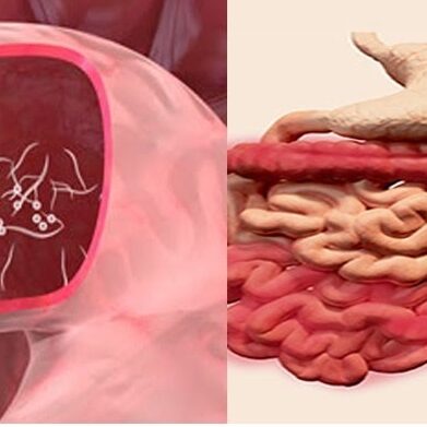 Λοίμωξη pinworm