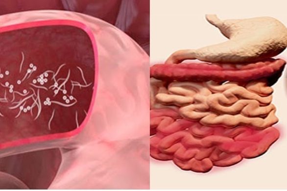 Λοίμωξη pinworm Λοίμωξη pinworm