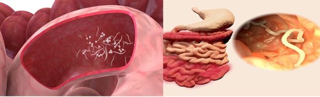 Λοίμωξη pinworm