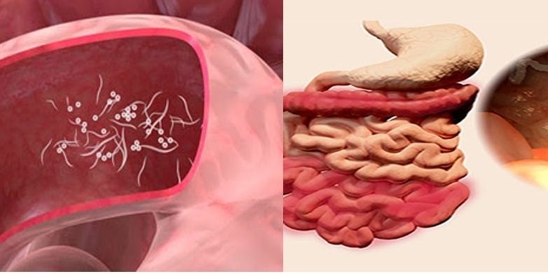 Λοίμωξη pinworm Λοίμωξη pinworm