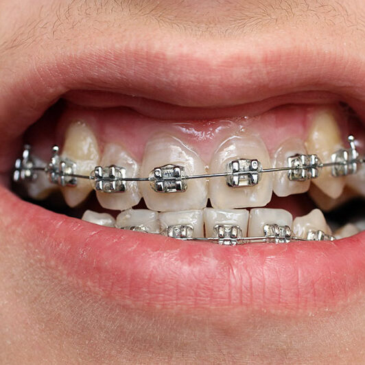 Μικροατυχήματα κατά την ορθοδοντική θεραπεία με σιδεράκια