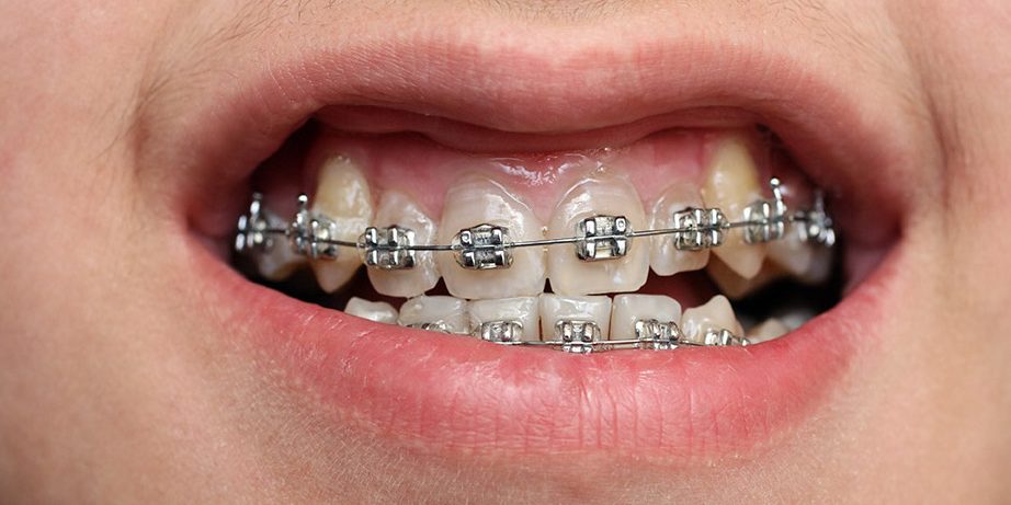 Μικροατυχήματα κατά την ορθοδοντική θεραπεία με σιδεράκια