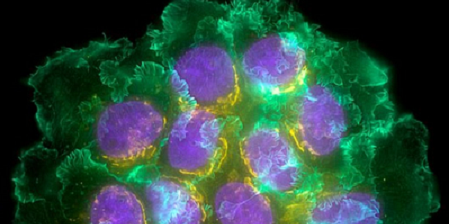 Μοριακή απεικόνιση μαστού