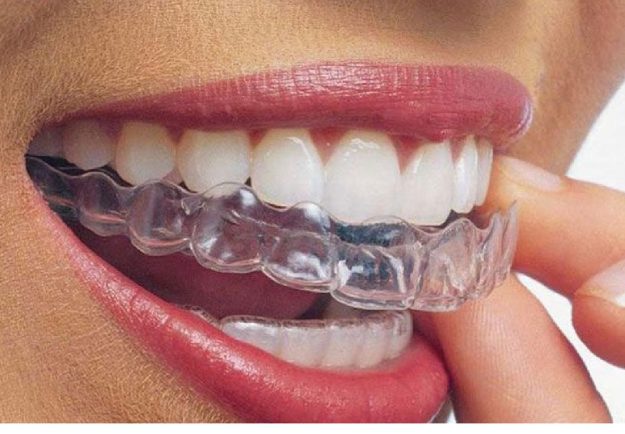 Μπορώ να αποκτήσω ίσια δόντια χωρίς σιδεράκια;