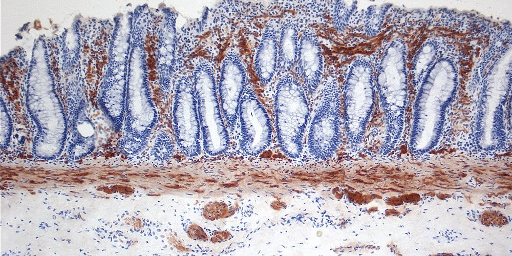 Νόσος Hirschsprung