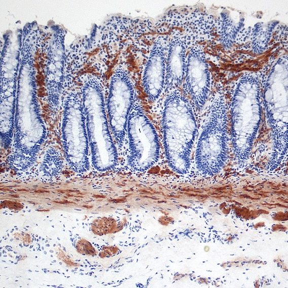 Νόσος Hirschsprung