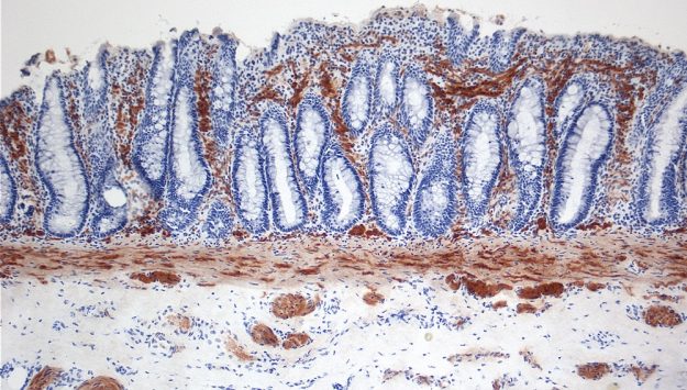 Νόσος Hirschsprung