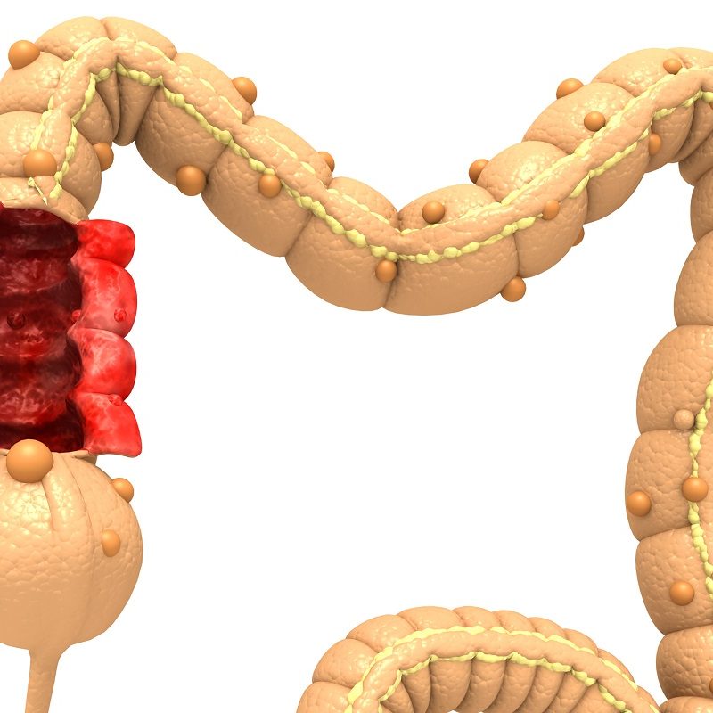 Νόσος του Crohn