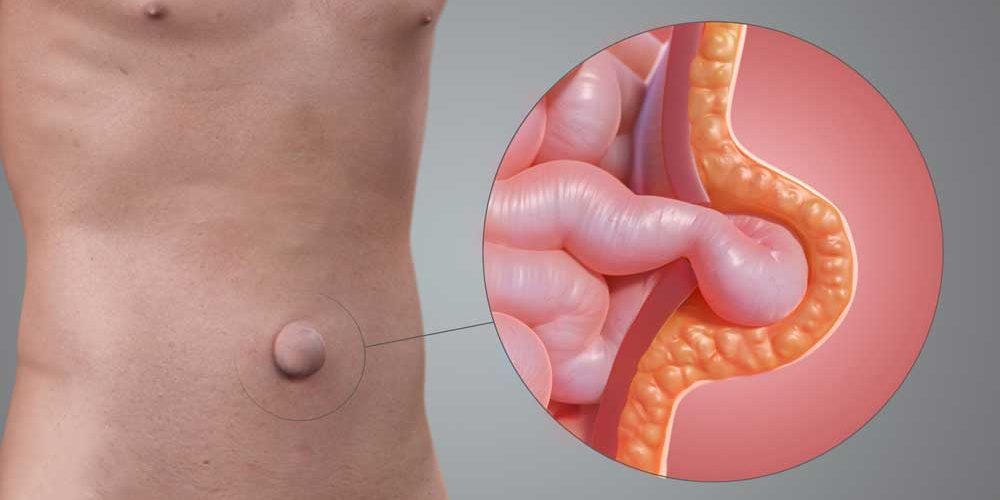 Ομφαλοκήλη: Αιτίες, συμπτώματα και θεραπεία Ομφαλοκήλη: Αιτίες, συμπτώματα και θεραπεία