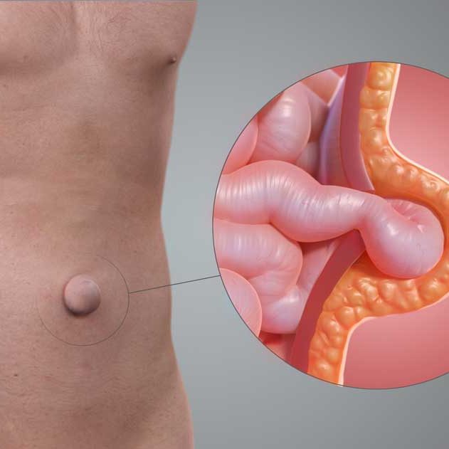 Ομφαλοκήλη: Αιτίες, συμπτώματα και θεραπεία