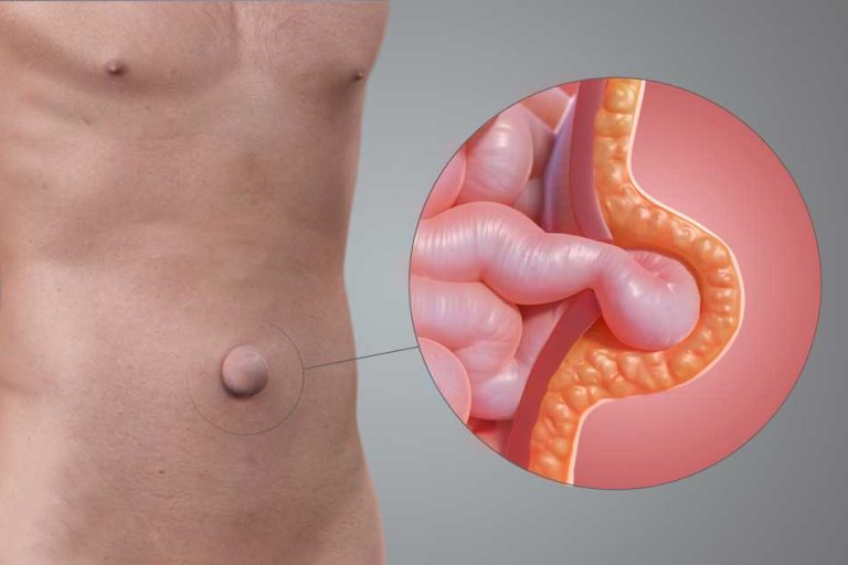 Ομφαλοκήλη: Αιτίες, συμπτώματα και θεραπεία