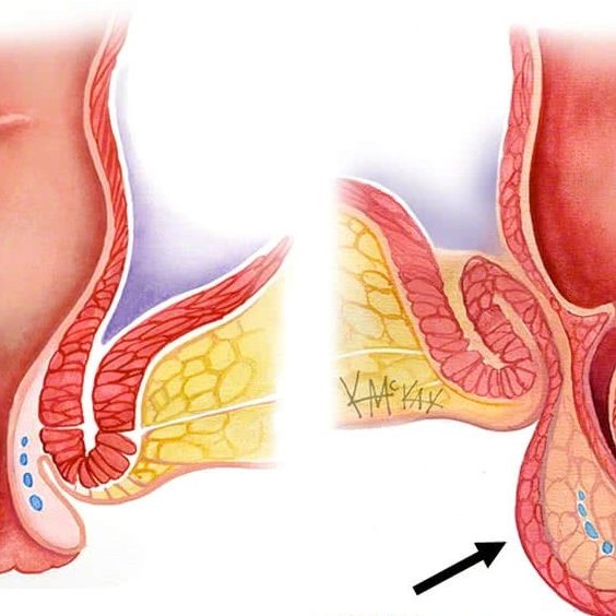 Ορθική πρόπτωση, αιτίες και συμπτώματα
