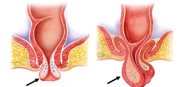Ορθική πρόπτωση, αιτίες και συμπτώματα