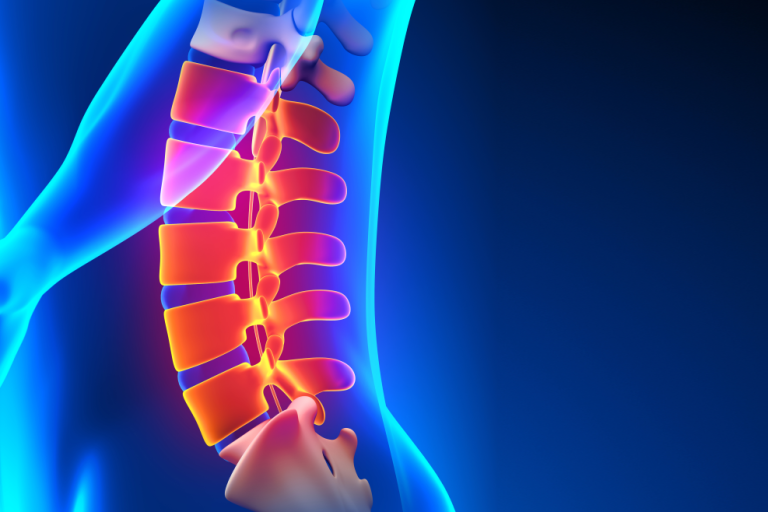 Οσφυϊκή Δισκεκτομή: Διαδικασία & Ανάρρωση