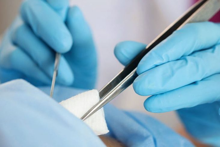 Περιτομή με Laser & Οφέλη Όλα όσα πρέπει να γνωρίζετε!