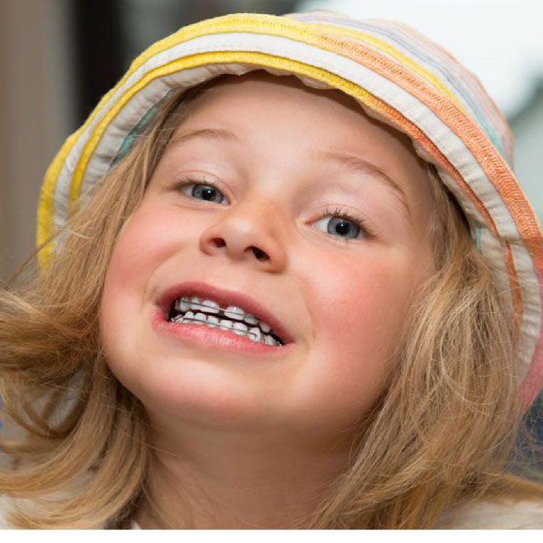 Ποια είναι η κατάλληλη ηλικία για ορθοδοντική θεραπεία;