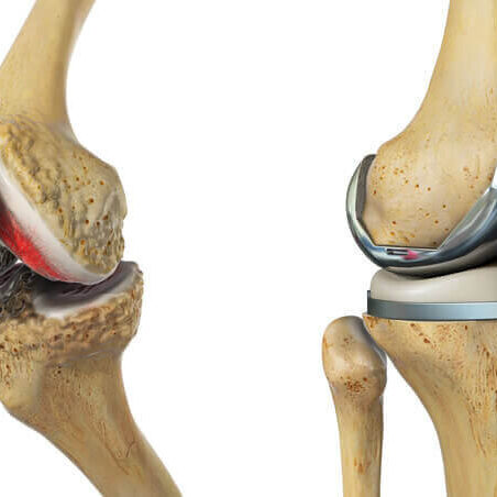 Ποια είναι τα Πλεονεκτήματα της Ολικής Αρθροπλαστικής Γόνατος PSI;