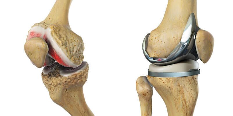 Ποια είναι τα Πλεονεκτήματα της Ολικής Αρθροπλαστικής Γόνατος PSI; Ποια είναι τα Πλεονεκτήματα της Ολικής Αρθροπλαστικής Γόνατος PSI;