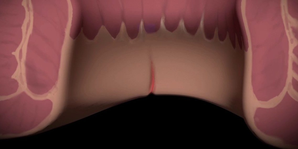 Ποια είναι τα συμπτώματα ενός πρωκτικού συριγγίου; Ποια είναι τα συμπτώματα ενός πρωκτικού συριγγίου;