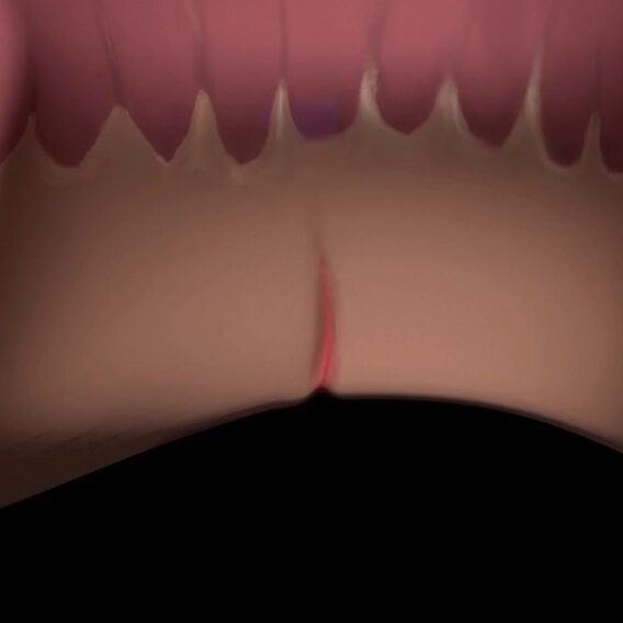 Ποια είναι τα συμπτώματα ενός πρωκτικού συριγγίου;