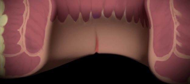 Ποια είναι τα συμπτώματα ενός πρωκτικού συριγγίου;