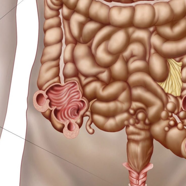 Ποια είναι τα συμπτώματα του καρκίνου του ορθού;