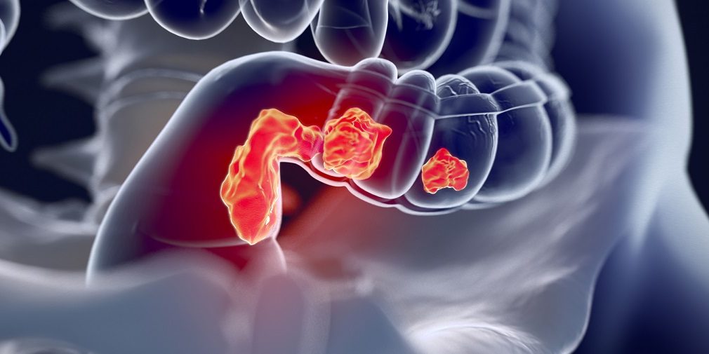 Προεγχειρητική ακτινοθεραπεία και καρκίνος του ορθού