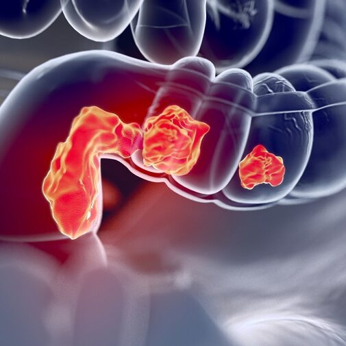 Προεγχειρητική ακτινοθεραπεία και καρκίνος του ορθού