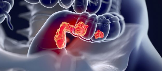 Προεγχειρητική ακτινοθεραπεία και καρκίνος του ορθού