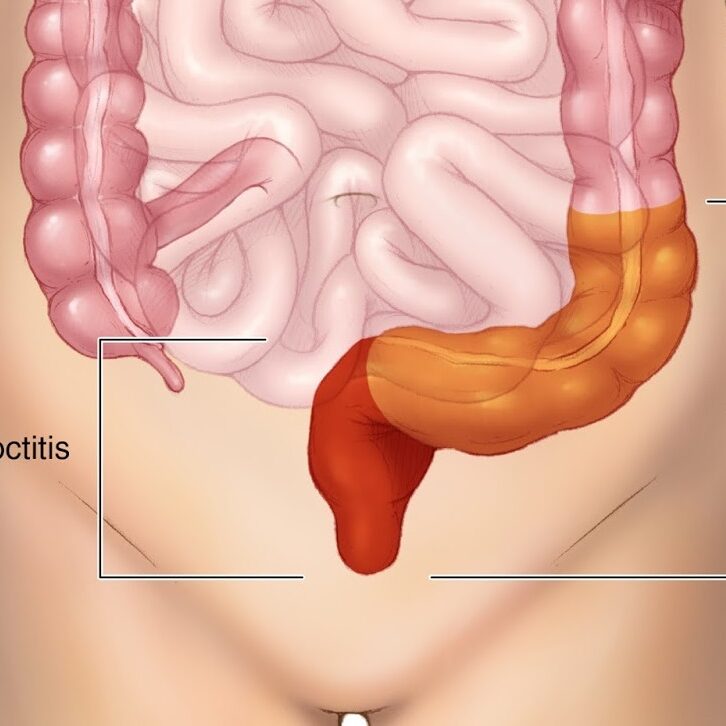 Πρωκτίτιδα: Αιτίες, συμπτώματα και θεραπείες