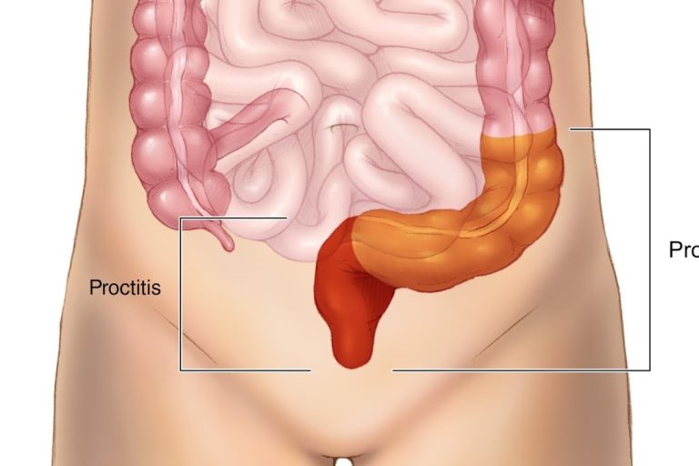 Πρωκτίτιδα: Αιτίες, συμπτώματα και θεραπείες