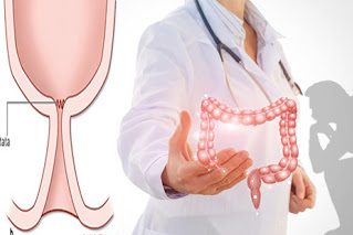 Πρωκτική στένωση