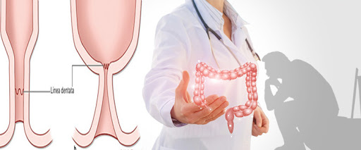 Πρωκτική στένωση