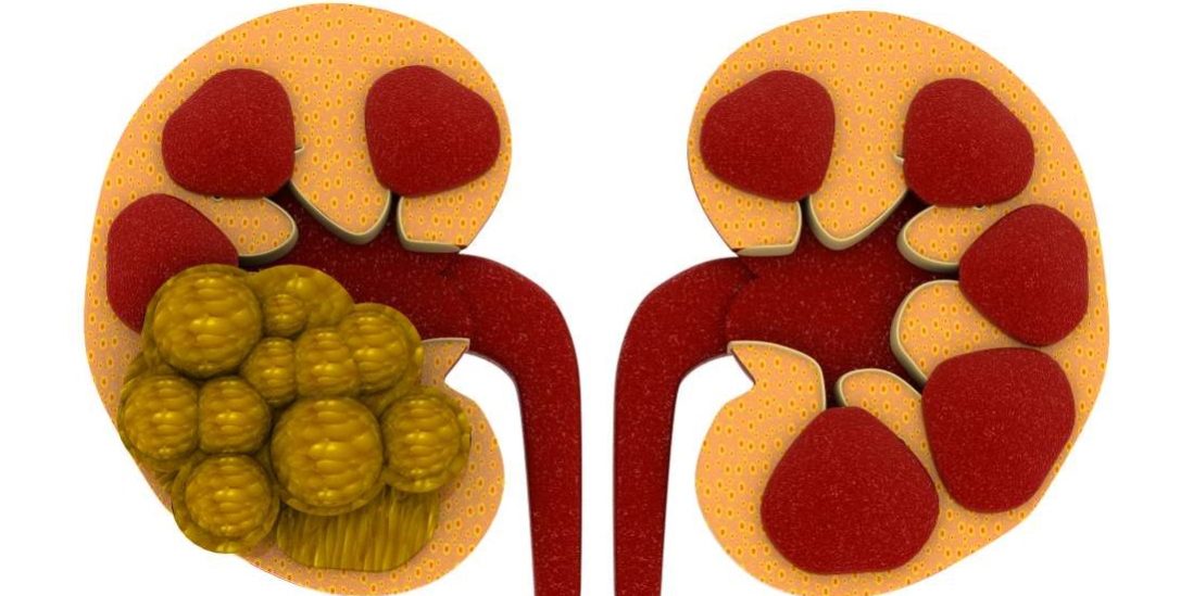 Πως δημιουργούνται οι πέτρες στα νεφρά; Πως δημιουργούνται οι πέτρες στα νεφρά;